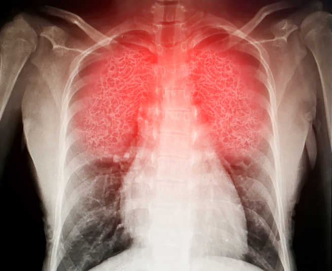 Radiograph of inflamed lungs